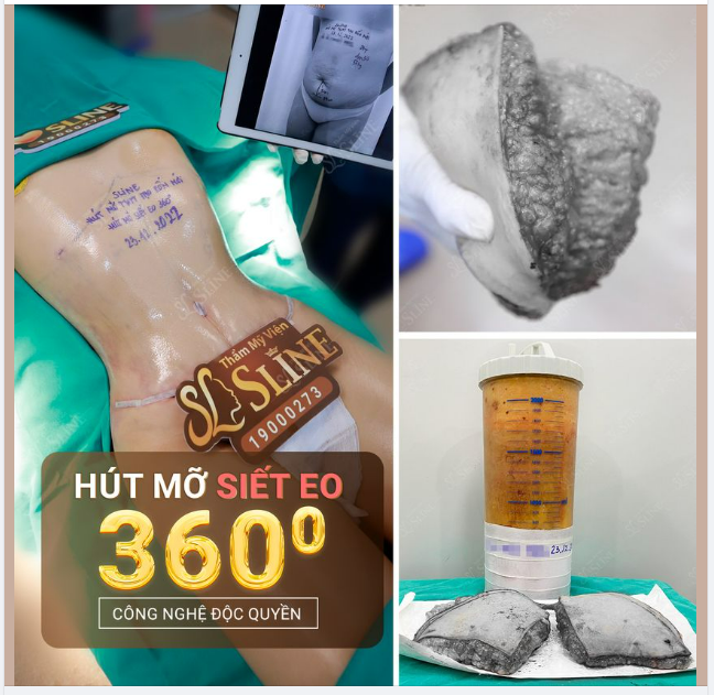 HỒI SINH vòng 2..với dịch vụ hút mỡ siết eo 360° đẹp hơn cả thời thanh xuân.