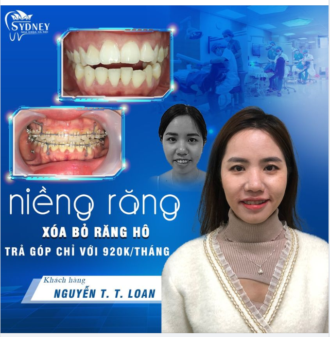 Niềng răng xóa bỏ răng hô với mắc cài trong suốt chỉ 920k/tháng