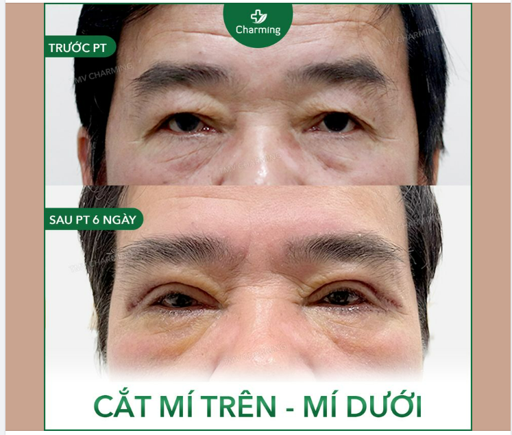 Đôi mắt là cửa sổ tâm hồn, tuy nhiên, khi thời gian dần trôi, đôi mắt lại là nơi đầu tiên "hứng chịu" những dấu vết của thời gian.
