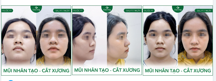Như bạn nữ trong ảnh này, chỉ cần giải quyết phần xương nền to thì dù nâng mũi bằng phương pháp nhân tạo thôi cũng đủ xuất sắc muôn phần rồi