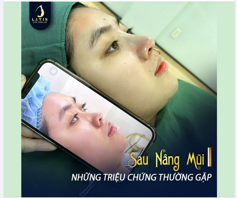 NHỮNG TRIỆU CHỨNG THÔNG THƯỜNG SAU NÂNG MŨI!