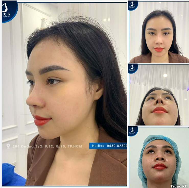 Tái khám sau 10 ngày nâng mũi cấu trúc sụn sườn, sóng surgiform