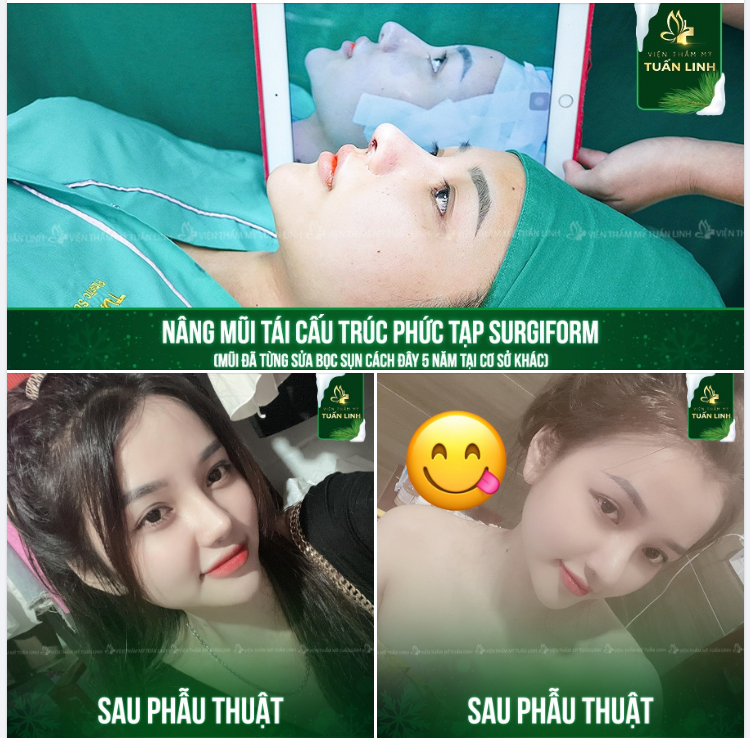 NÂNG MŨI TÁI CẤU TRÚC PHỨC TẠP SỬ DỤNG SỤN SURGIFORM 
