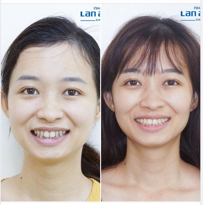 Trong lúc niềng răng mà ốm đi, hốc hác thì dễ, nhưng làm sao để đẹp hơn mới là khó!