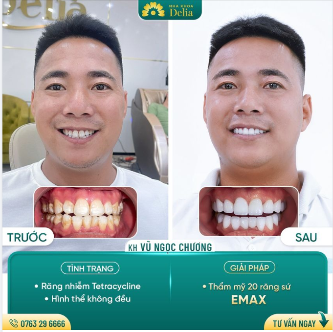 Thẩm mỹ 20 răng sứ Emax giúp khách hàng Vũ Ngọc Chương