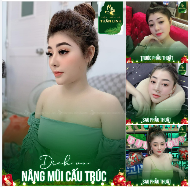Làm sao để sở hữu GƯƠNG MẶT KHÔNG TUỔI - TRẺ ĐẸP XINH SANG!!  Đó chính là thay đổi dáng mũi để trở nên thần thái hơn, góc nghiêng chuẩn tỉ lệ vàng.