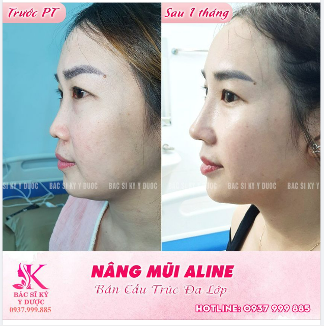 Cả nhà cùng nhìn kết quả nâng mũi sau 1 tháng nha.