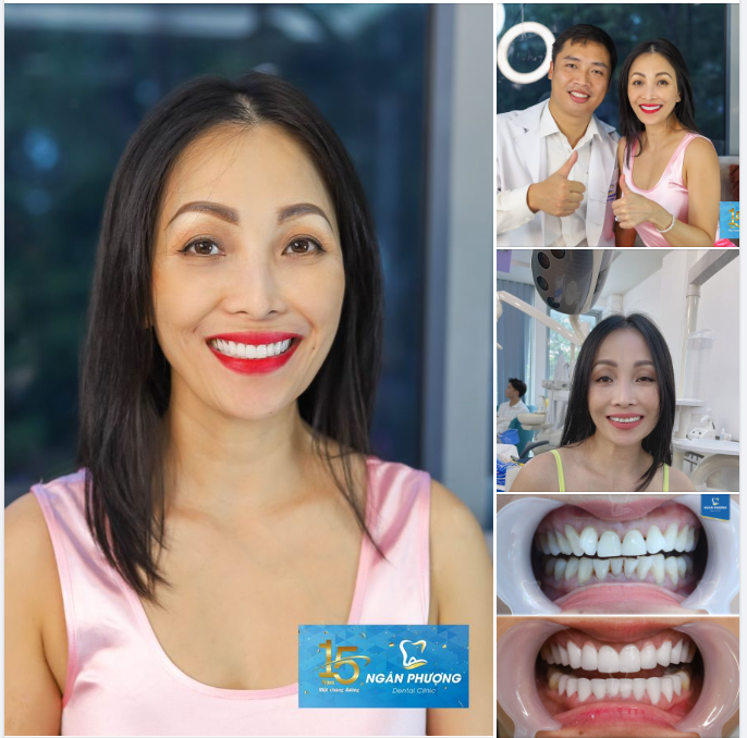 Răng đẹp xinh cho chị Việt kiều Texas