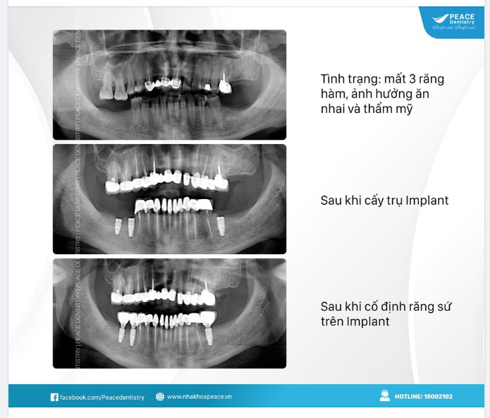 TRỒNG RĂNG IMPLANT - THỜI ĐIỂM NÀO LÀ LÝ TƯỞNG?