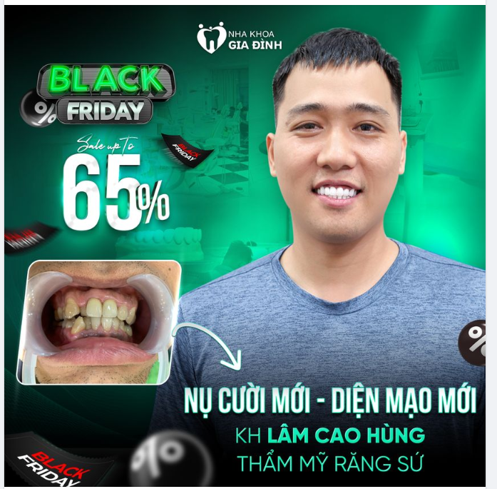 GIẢI PHÁP RĂNG XỈN MÀU, KHẤP KHỂNH THĂNG HẠNG NHAN SẮC CHO PHÁI MẠNH