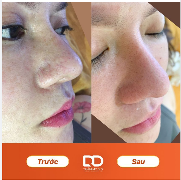 TRỊ SẠCH MAO MẠCH - ĐÓN TẾT RẠNG NGỜI