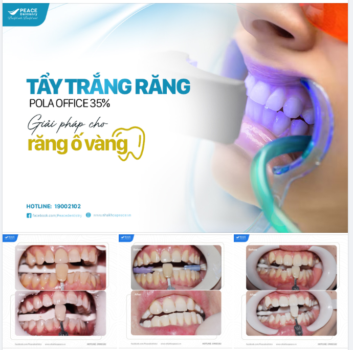 CÔNG NGHỆ TẨY TRẮNG RĂNG HIỆN ĐẠI TẠI PEACE DENTISTRY: