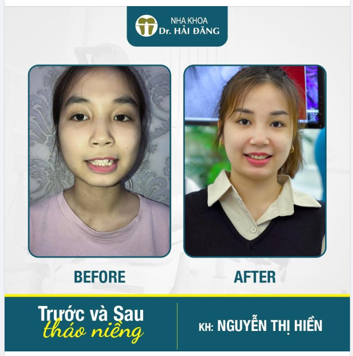 CHÚC MỪNG NGÀY THÁO NIỀNG