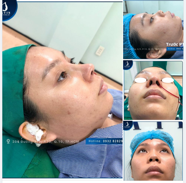 Giờ này nâng mũi có kịp ăn Tết không