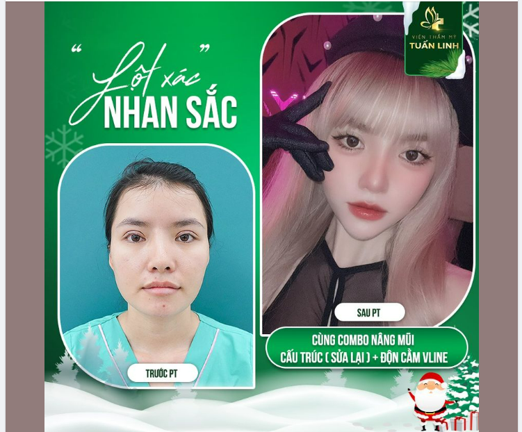 COMBO NÂNG MŨI ĐỘN CẰM CHO NHAN SẮC TỎA SÁNG
