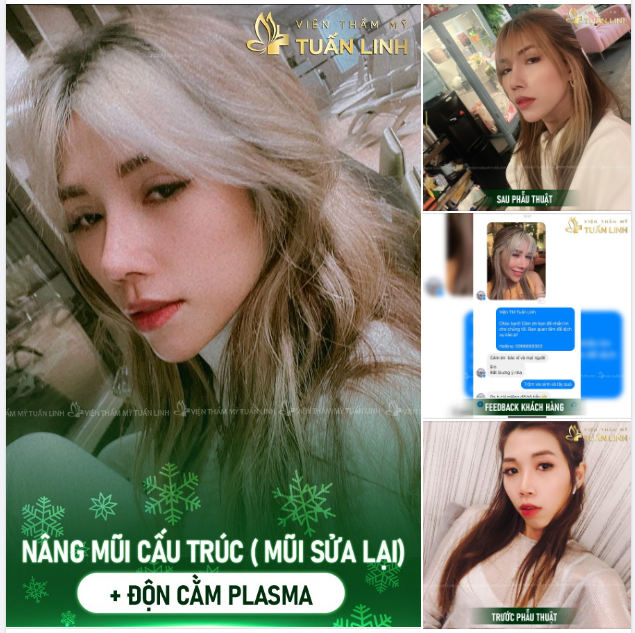 NÂNG MŨI NHẬN ƯU ĐÃI LỚN Tặng ngay ĐỘN CẰM trị giá 11TR