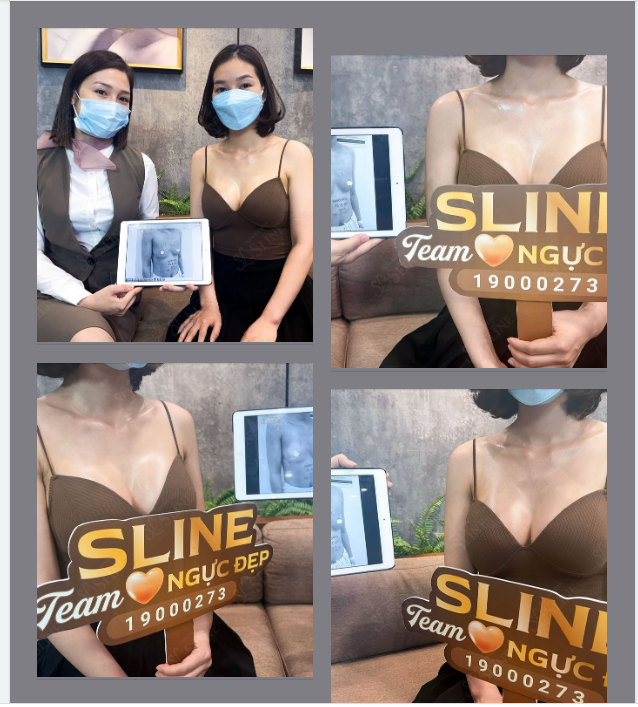 Ngực đã đặt túi và chưa đặt túi  khác nhau thế nào ?