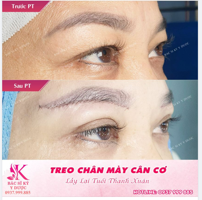 TREO CHÂN MÀY CÂN CƠ LẤY LẠI THỜI SON TRẺ