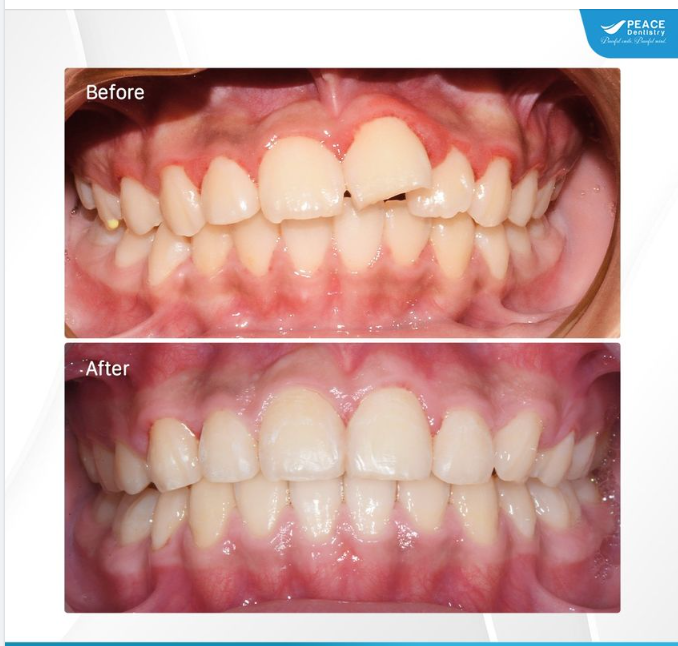 Ca lâm sàng niềng răng chỉnh răng lệch lạc hiệu quả (tháo niềng sau 20 tháng)