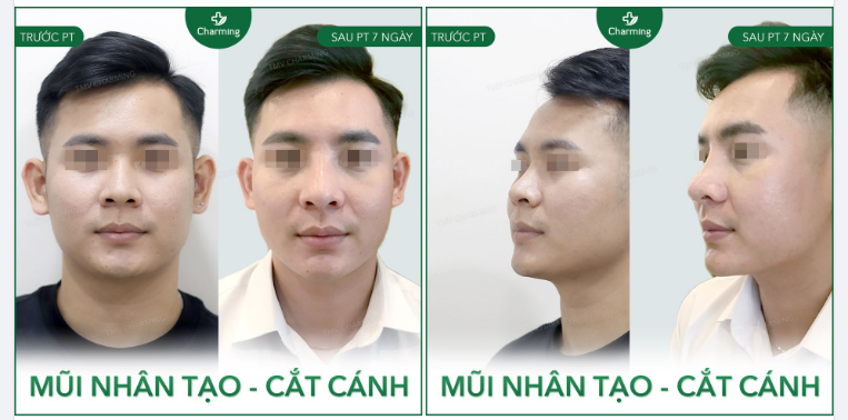 Bạn nam dù có dáng mũi cao đáng mơ ước nhưng tiếc nỗi mũi lại khá ngắn và cánh hơi to.