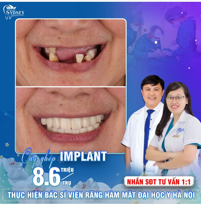 Ưu điểm khi cấy ghép Implant toàn hàm