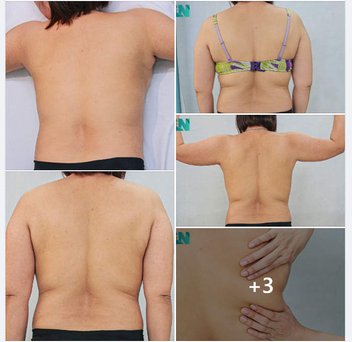  HÚT MỠ TẠO DÁNG THẨM MỸ VÙNG LƯNG, CÁNH TAY, NÁCH CHO CHỊ KH THÂN THUỘC – THỰC HIỆN NHIỀU DỊCH VỤ THẨM MỸ TẠI EKIP BÁC SĨ LƯƠNG NGỌC.