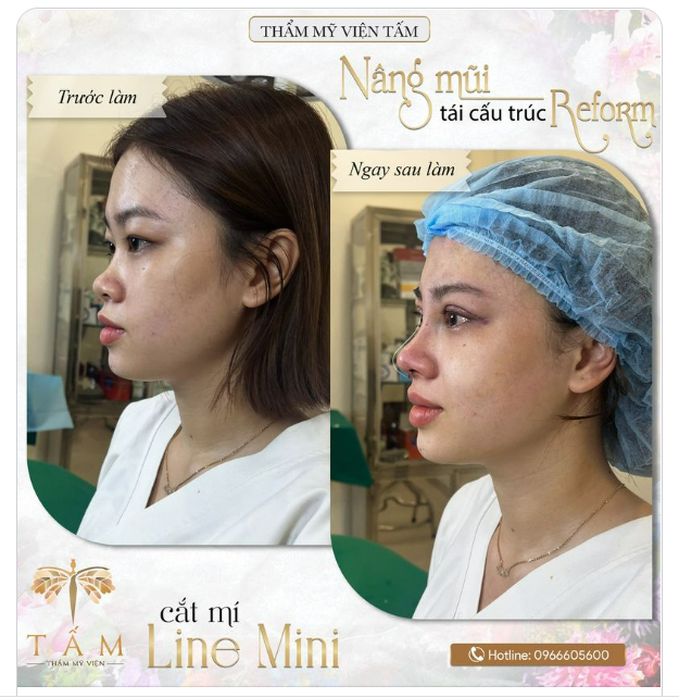 Bộ đôi Nâng mũi Tái cấu trúc Reform và Cắt mí Line Mini thay đổi nhan sắc ngoạn mục!!