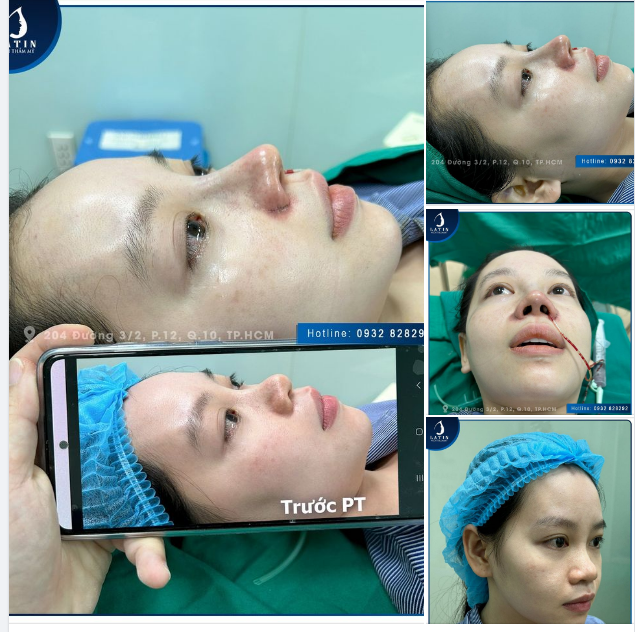 Nâng mũi bán cấu trúc - Đón Tết dáng mũi xinh