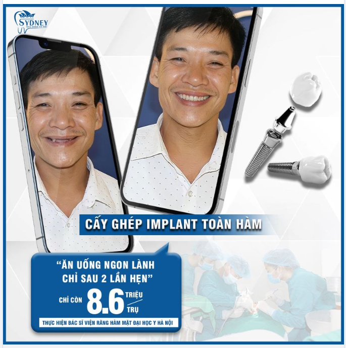 Cấy ghép Implant – Ăn ngon hơn, nhai khỏe hơn, cười tươi hơn