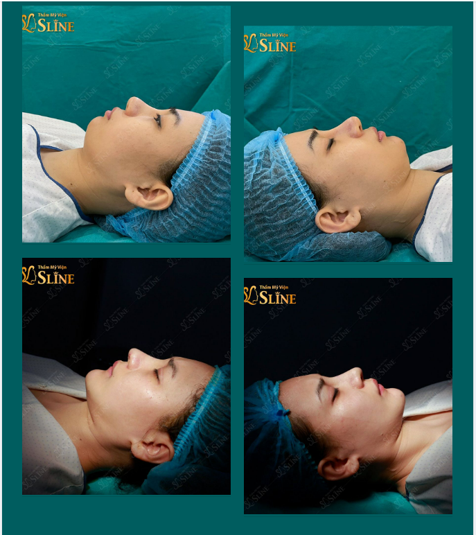 Nâng mũi chỉ từ 14 triệu đồng !