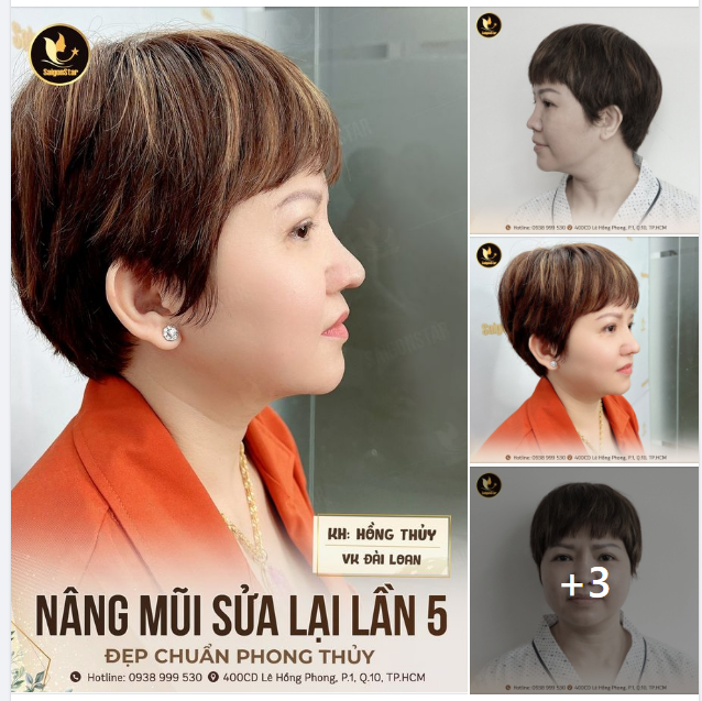 NÂNG MŨI SỬA LẠI LẦN 5 ĐẸP CHUẨN PHONG THỦY