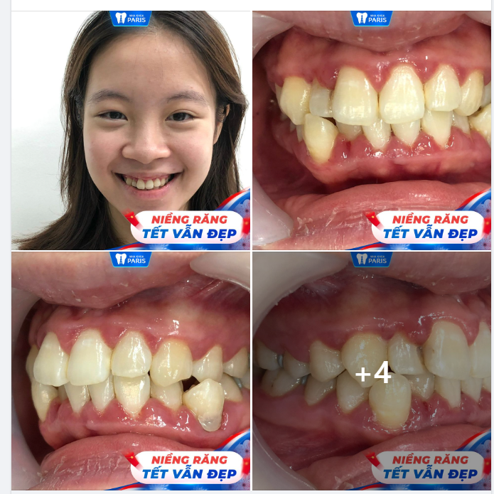 Niềng răng hết nhiệt miệng, khấp khểnh của cô sinh viên ĐH Ngoại Thương tại nha khoa Paris.