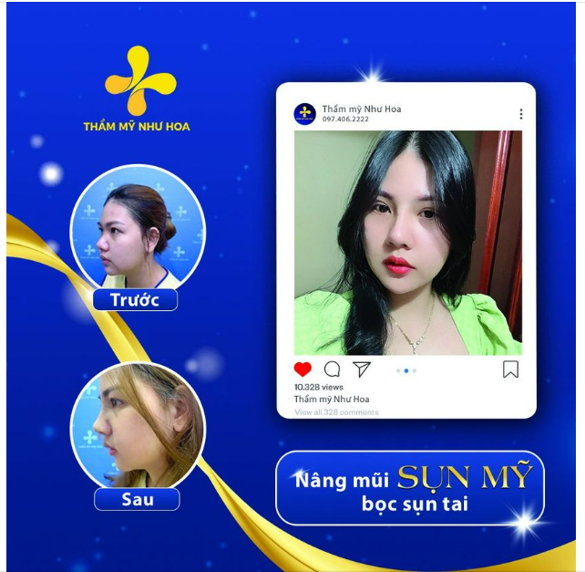 Mũi đẹp chuẩn Á Đông nhưng không kém phần sang chảnh, thời thượng.