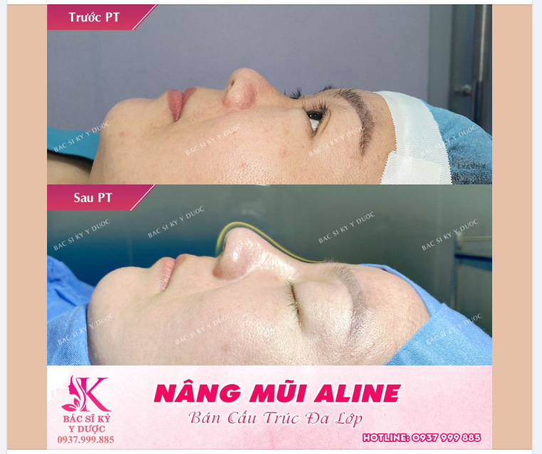 Nâng mũi ALINE tại Bác sĩ Kỳ Y Dược giúp nâng cao sống mũi, cải thiện đầu mũi và chiếc mũi trở nên thanh thoát, tự nhiên.