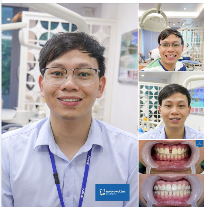 Kéo khít khe thưa, đón nụ cười mới