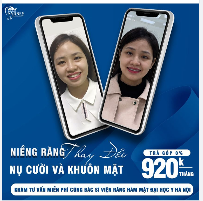 Niềng răng giảm hô với mắc cài pha lê
