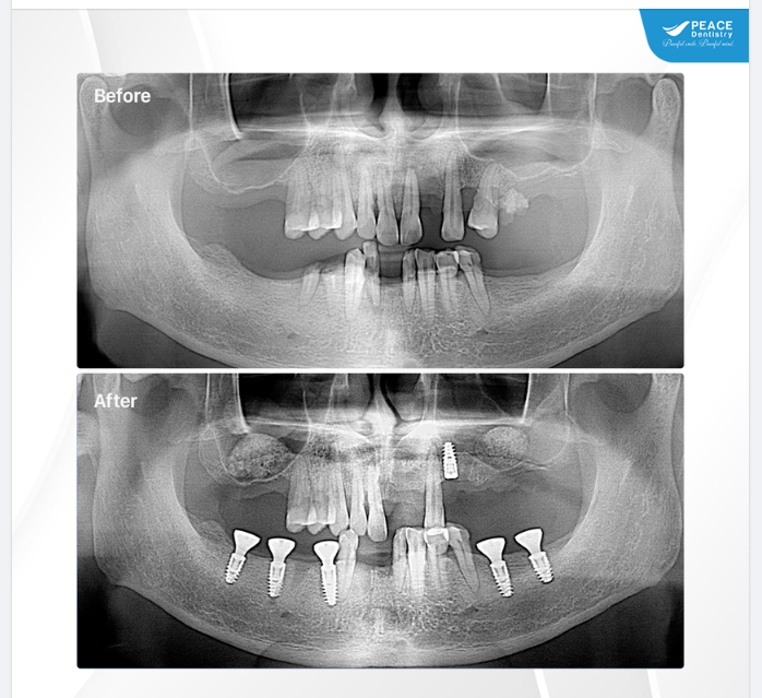 Chỉ cần thêm giai đoạn phục hình răng sứ trên Implant, khách hàng sẽ có những chiếc "răng Implant" ăn nhai khỏe, thẩm mỹ cao