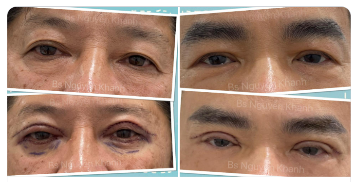 Mọi người hay hỏi: a ơi, nam giới cắt mắt được kg? Sao lại kg đc nhỉ? Nữ có nhu cầu làm đẹp thì sao nam lại kg?