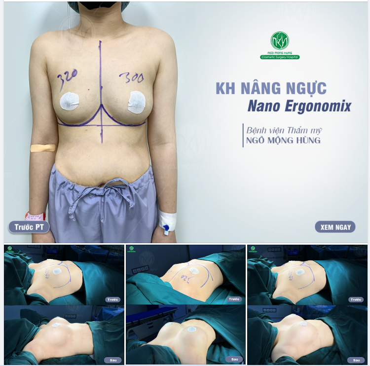 KH được gì sau thực hiện nâng ngực với dòng túi Nano Ergonomix