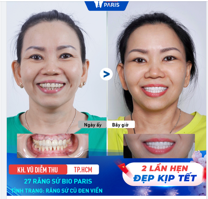 Cuối năm cận Tết, các chị em nô nức đến nha khoa Paris "tút tát" hàm răng, nụ cười để kịp xinh đẹp du xuân
