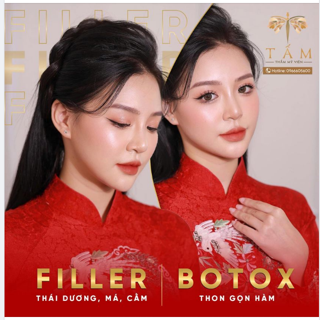 Thay đổi vận mệnh đón năm mới tài lộc với combo Botox - Filler