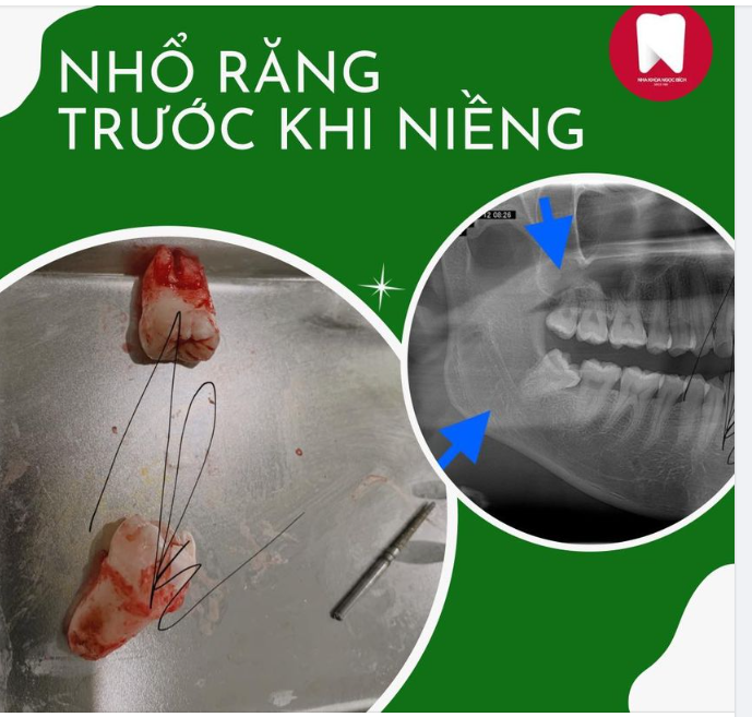 NHỔ RĂNG ĐỂ CHUẨN BỊ NIỀNG INVISALIGN