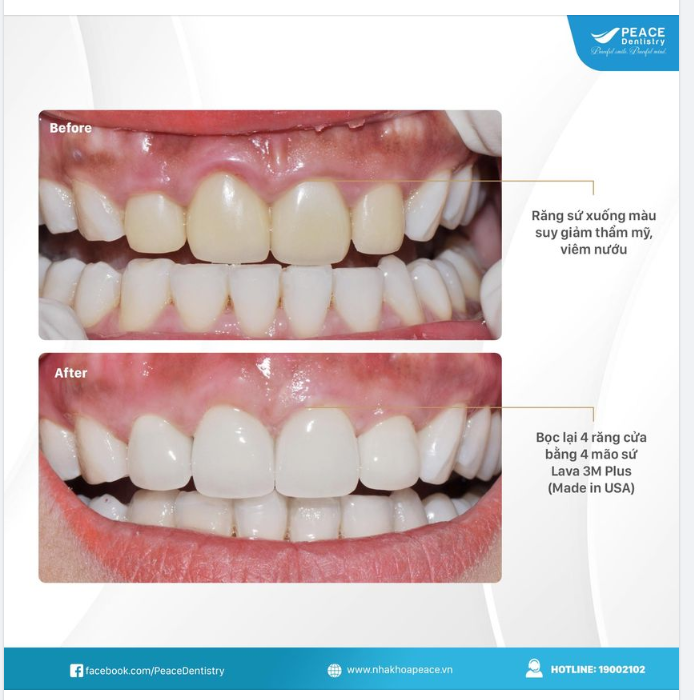 Ca lâm sàng thẩm mỹ răng sứ giải pháp lí tưởng cải thiện nụ cười