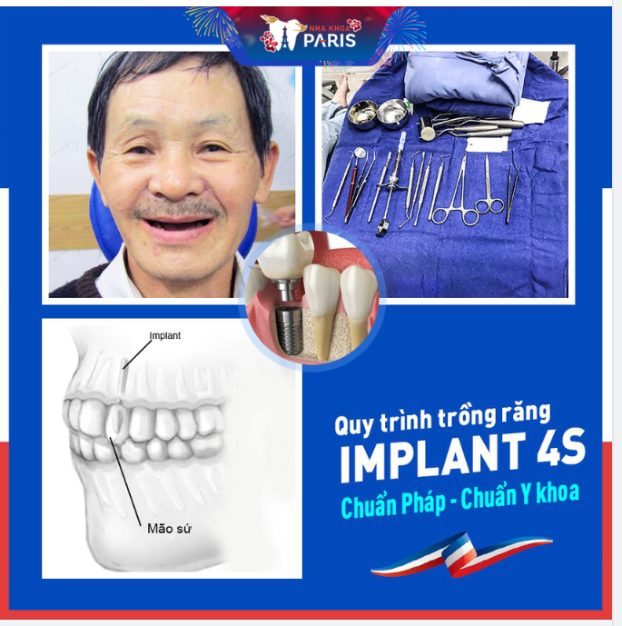 TÌM HIỂU VỀ QUY TRÌNH CẤY GHÉP IMPLANT AN TOÀN - HIỆN ĐẠI NHẤT THẾ GIỚI!