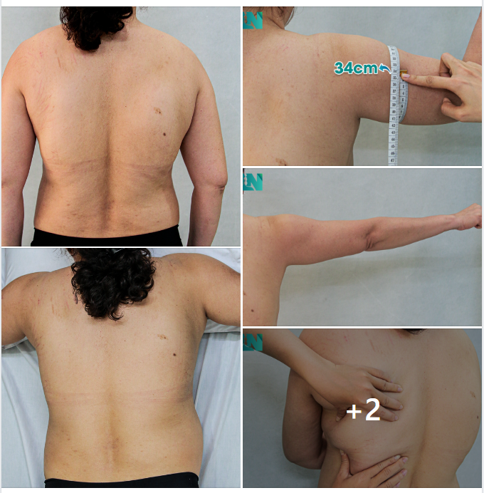  HÚT MỠ TẠO DÁNG THẨM MỸ TAY – LƯNG – NÁCH CHO CÔ KH ĐƯỢC CON GÁI “THÁP TÙNG” ĐẾN BỆNH VIỆN THỰC HIỆN.