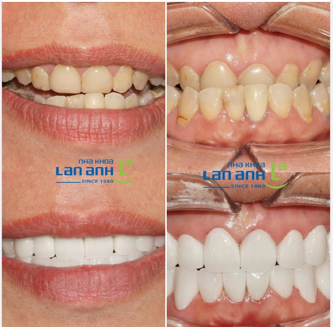 Một trường hợp phục hình răng sứ 2 hàm của BS Dũng chi nhánh 149-Tôn Dật Tiên-Phú Mỹ Hưng-Quận 7