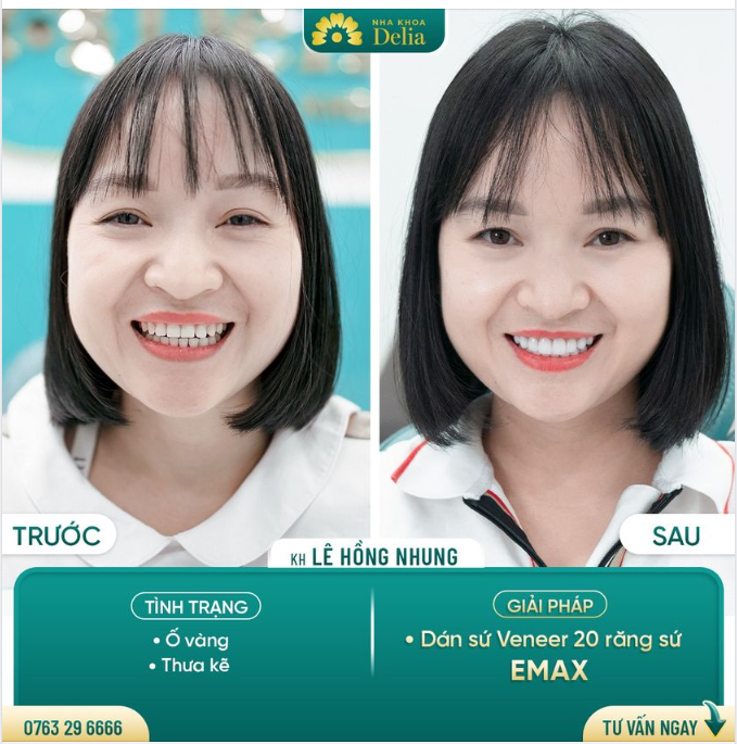 DÁN SỨ VENEER KHÔNG MÀI NHỎ