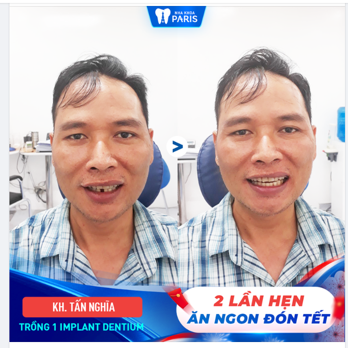 2 NGÀY TRỒNG RĂNG KỊP ĐÓN TẾT