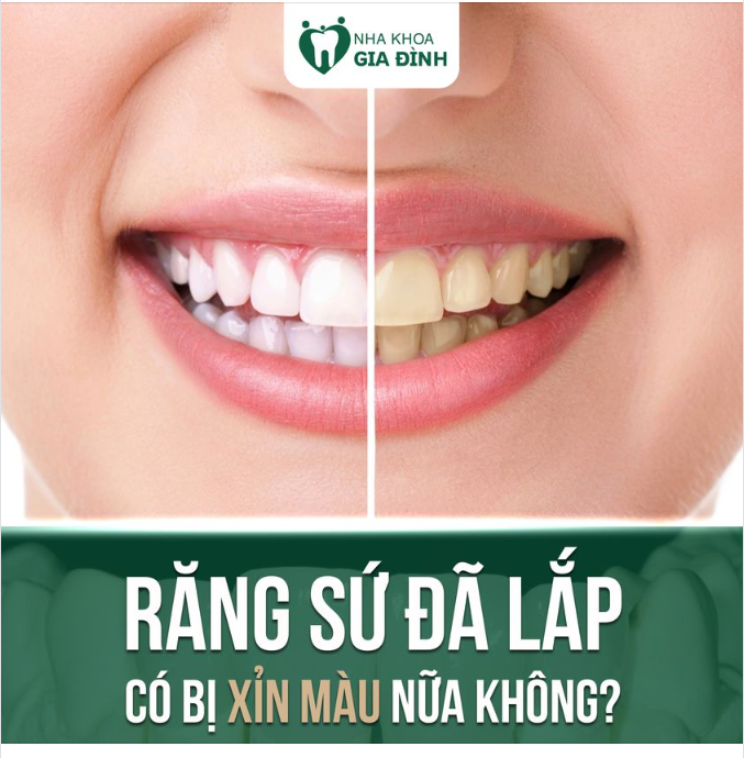 RĂNG BỌC SỨ CÓ CÒN ĐỔI MÀU ĐƯỢC NỮA KHÔNG?