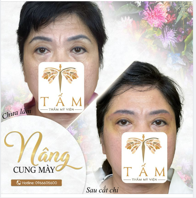 Bí kíp giúp gương mặt trẻ ra 10 tuổi với Nâng cung chân mày